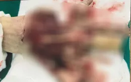 Biến dạng bàn tay do máy ép gạch bê tông