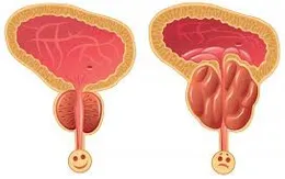 Nam giới nào dễ mắc ung thư tiền liệt tuyến?
