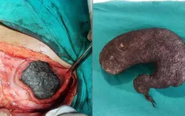 Phẫu thuật lấy búi tóc nặng 1kg trong dạ dày bé gái 6 tuổi