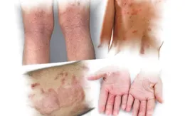 Chăm sóc da ở bệnh nhân viêm da cơ địa