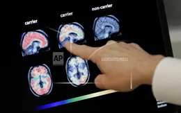 Bệnh Alzheimer có thể bắt đầu khi còn trong bụng mẹ