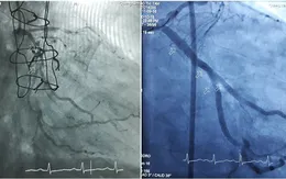 Đặt cùng lúc 3 stent cứu sống người phụ nữ khỏi tử thần