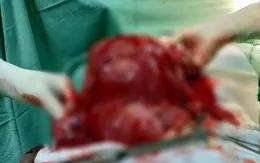 Bóc tách khối u nang nặng 4 kg trong tử cung người phụ nữ