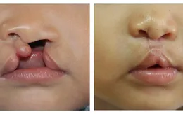 Chương trình Phẫu thuật "Vì nụ cười trẻ thơ" năm 2019 tại Quảng Ninh