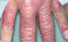 Tuần lễ khám miễn phí bệnh vảy nến tại Bình Định