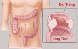 Ăn gì để phòng tránh ung thư đại trực tràng?