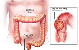 Đừng nhầm lẫn ung thư đại trực tràng với rối loạn tiêu hóa