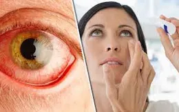 Lấy vật lạ rơi vào mắt thế nào cho đúng?
