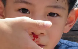 Khi trẻ chảy máu cam cần làm gì?