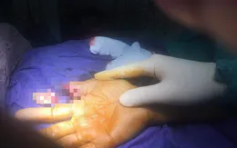 Người đàn ông vào viện với đốt ngón tay đứt rời, vết thương nham nhở