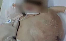 Phẫu thuật thành công khối bướu khổng lồ trên cơ thể trẻ sơ sinh