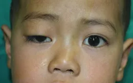 Điều trị sụp mi bằng kĩ thuật chuyển vạt cơ trán