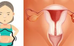 U nang buồng trứng có dẫn đến ung thư?
