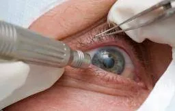 Những điều cần biết về bệnh đục thủy tinh thể