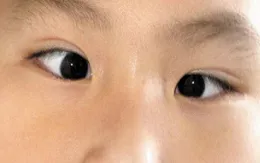 Mắt lé - bệnh về mắt gây giảm thị lực, thẩm mỹ