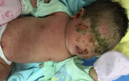 Trẻ 1 tháng tuổi viêm da chảy mủ toàn thân do tắm lá cây