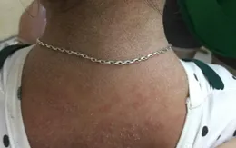 Bé gái bong tróc toàn thân do mắc hội chứng bong vảy da do tụ cầu