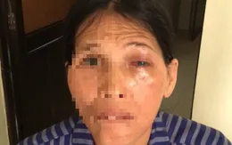 Suýt hỏng mắt vì đắp lá chữa đau mắt