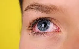 Bệnh glôcôm: Những triệu chứng dễ bị bỏ qua
