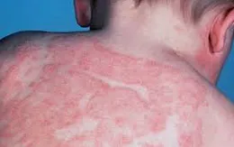 Viêm da cơ địa, nỗi khổ mùa hanh khô
