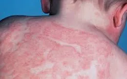 Lưu ý chăm sóc da cho trẻ bị viêm da cơ địa trong mùa hè