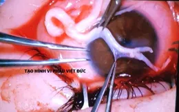 Nối sợi thần kinh 1mm vào giác mạc phục hồi cảm giác cho mắt