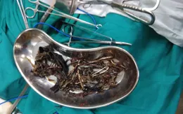 Tìm thấy 1,5kg kim loại trong dạ dày một người phụ nữ Ấn Độ