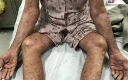 Tự ý dùng thuốc trị bệnh gout, cụ bà bị đỏ da toàn thân