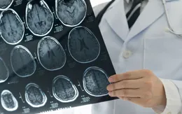 Anh thử nghiệm điều trị bệnh xốp não nguy hiểm