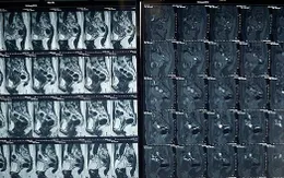 Chấm dứt 15 năm đau đớn vì lạc nội mạc tử cung