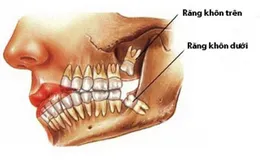 Răng khôn: Nỗi ám ảnh không của riêng ai