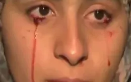 Kỳ lạ căn bệnh “khóc ra máu”