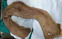 Nam thanh niên bị máy bóc vỏ gỗ lột toàn bộ da cánh tay