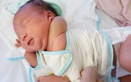 Nghệ An: Điều trị u bạch mạch bẩm sinh không cần phẫu thuật