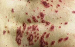 Uống thuốc bừa bãi, người đàn ông bị bỏng rát khi tiếp xúc với ánh nắng