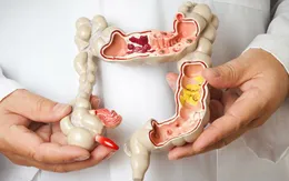 Điều trị ung thư ruột hiệu quả bằng thuốc giá rẻ