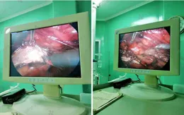 Nội soi tạo hình khúc nối bể thận - niệu quản cho bệnh nhân bị thận ứ nước