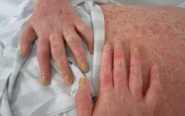 Viêm khớp vảy nến: Bệnh cần được chăm sóc đa chuyên khoa