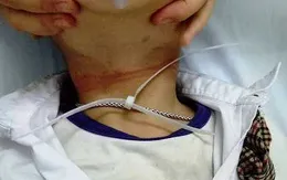 Bé trai 6 tuổi suýt chết vì bị dây nhựa thắt cổ