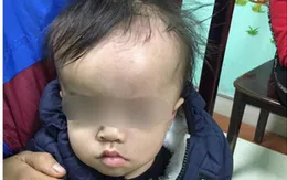 Đầu trẻ sơ sinh to lên bất thường - dấu hiệu của căn bệnh nguy hiểm