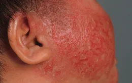 Cách chăm sóc da cho trẻ viêm da cơ địa