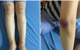 Trẻ xuất huyết dưới da toàn thân do mắc bệnh viêm mao mạch dị ứng