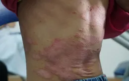 Bệnh vảy nến: Nên và không nên ăn gì?