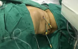 Nội soi tán sỏi đường mật qua da bằng laser công suất cao