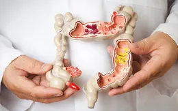 Tầm soát ung thư đường tiêu hóa