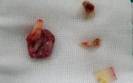 Đi khám vì đau má, bé 8 tuổi được chẩn đoán u nang xương hàm