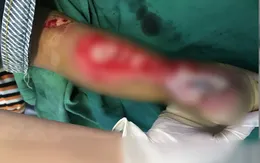 Bé gái 2 tuổi bị nan xe máy bào thịt, cắt đứt gân chân