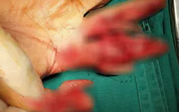 Dập nát bàn tay do máy thái thịt