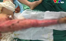 Sang Trung Quốc làm việc bé trai 12 tuổi bị tai nạn lóc da