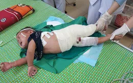 Đáng thương bé trai 2 tuổi người dân tộc ngã vào nồi nước sôi nguy kịch